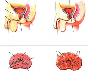 prostata normale e prostatite cronica