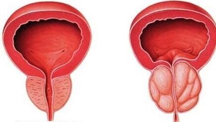 prostata normale e infiammata