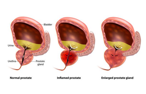 La prostatite è un'infiammazione della prostata
