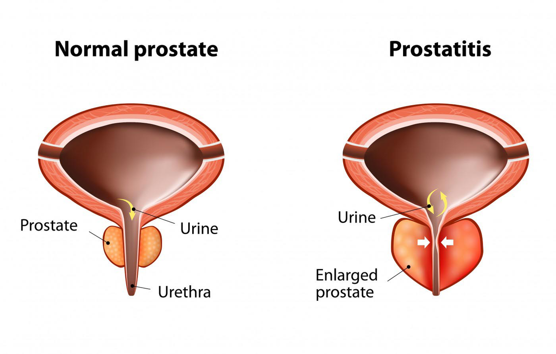 Prostata normale di un uomo sano e infiammazione della prostata con prostatite
